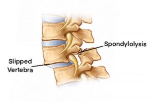 اسپوندیلولیستزیس