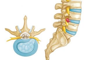 فتق دیسک کمر